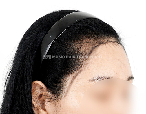 이마거상 흉터커버 절개 모발이식 before