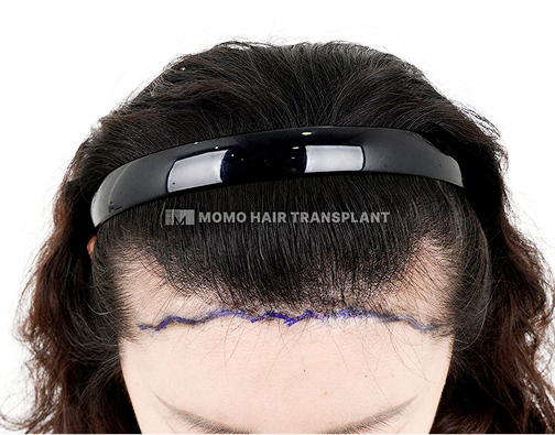 이마거상 흉터커버 비절개 모발이식 before