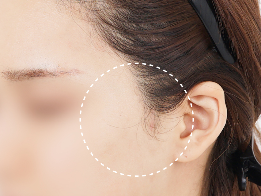 윤곽 / 리프팅 후 구레나룻 흉터