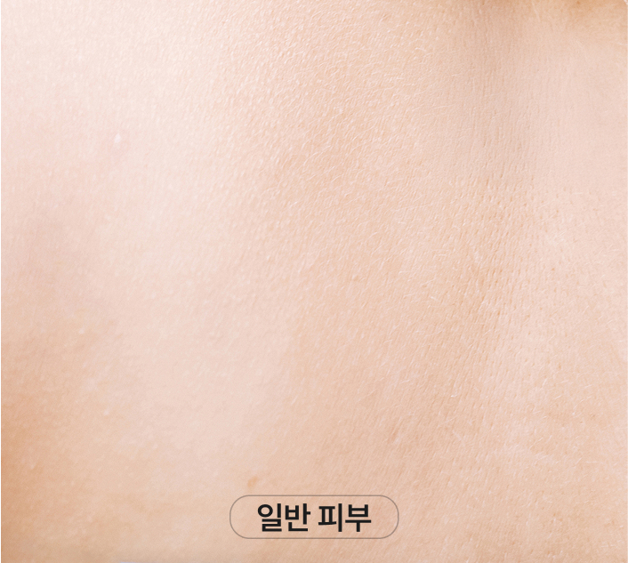 수술로 인한 헤어라인 변형