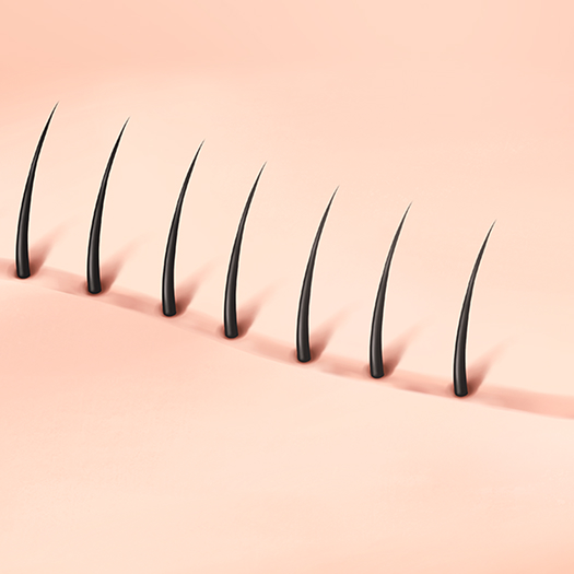 흉터커버 모발이식 수술 과정 01