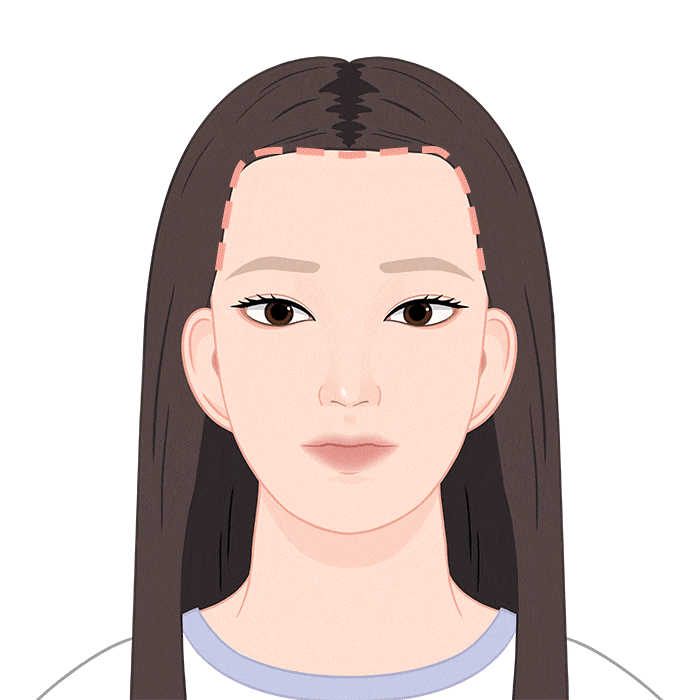 흉터커버 모발이식 수술 과정 03