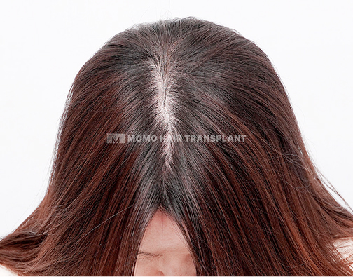 여성 정수리 모발이식 after