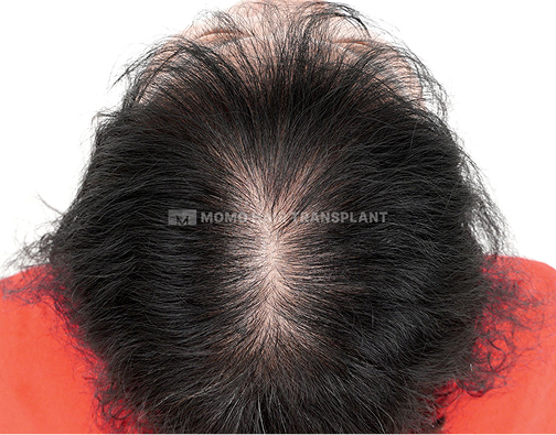 여성 정수리 모발이식 after