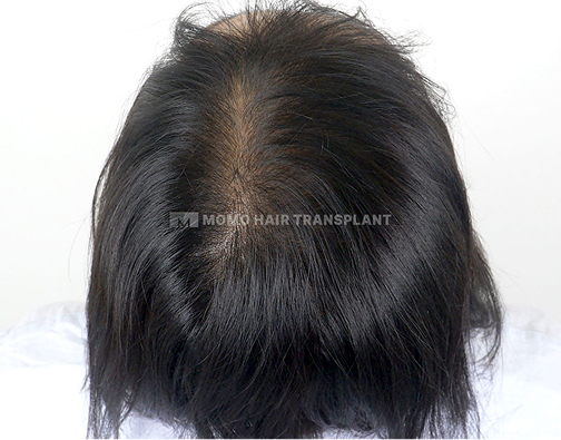여성 정수리 모발이식 after