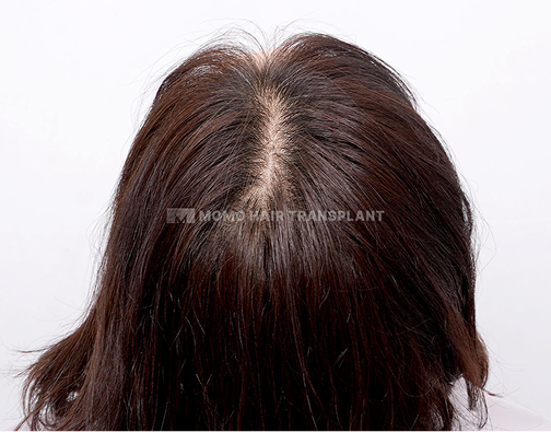 여성 정수리 모발이식 after