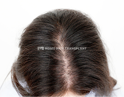 여성 정수리 모발이식 after