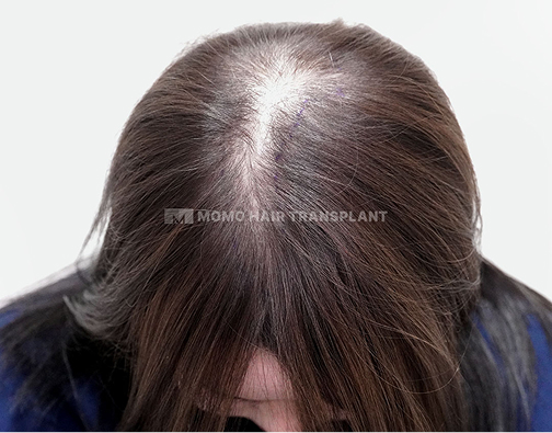 여성 정수리 모발이식 before