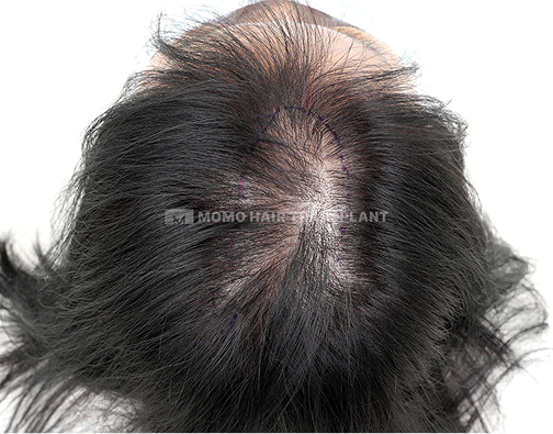 여성 정수리 모발이식 before