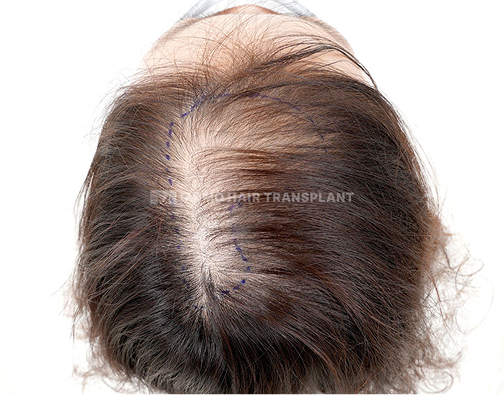 여성 정수리 모발이식 before