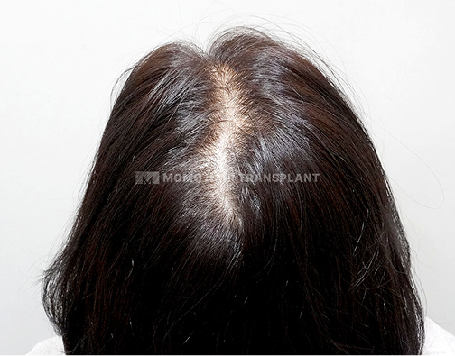 여성 정수리 모발이식 before