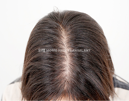 여성 정수리 모발이식 before