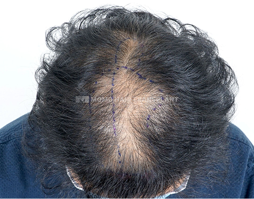 여성 정수리 모발이식 before