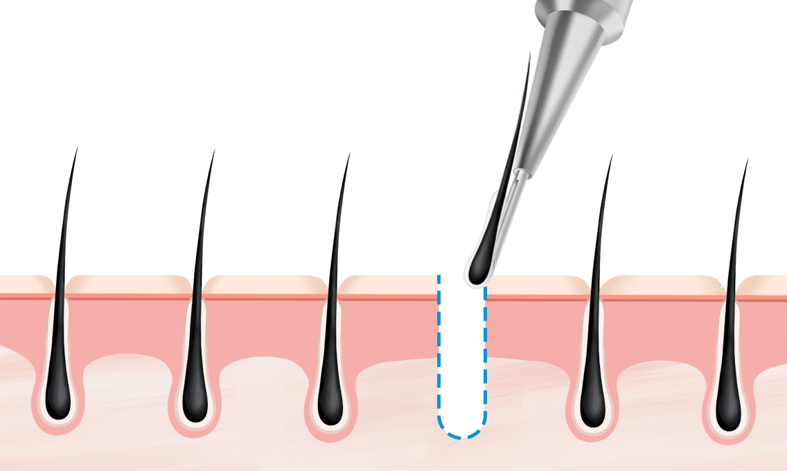 정확한 이식 테크닉