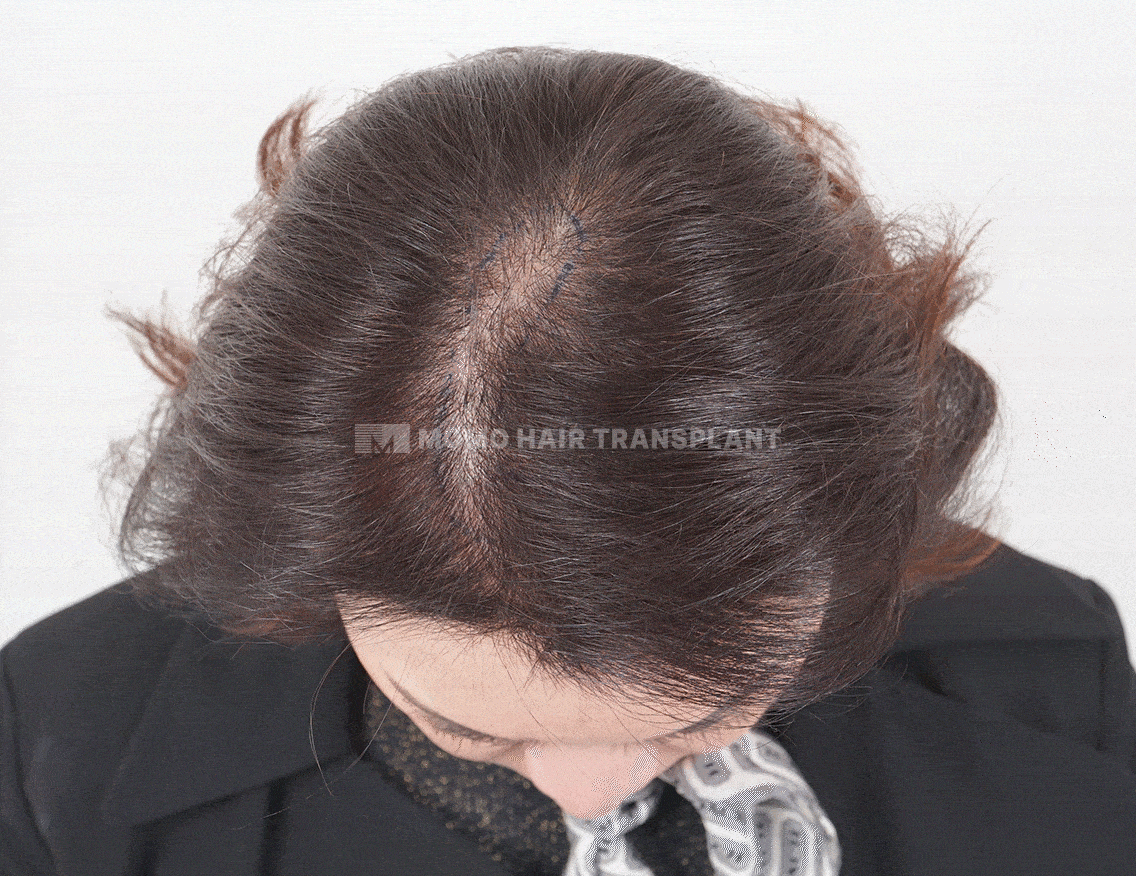 고난이도 정수리 모발이식