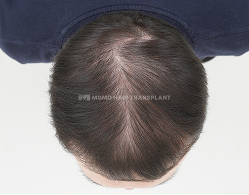여성 정수리 모발이식 before
