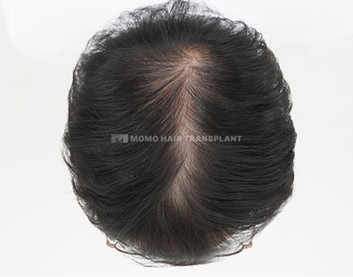 여성 정수리 모발이식 before